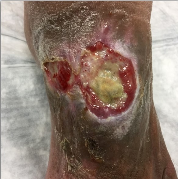 Patient had a diabetic ulcer on his left foot